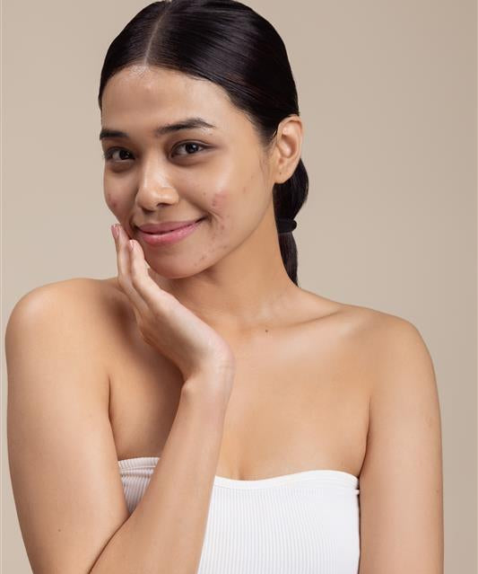 How to Build a Basic Skincare Routine for Acne-Prone Skin