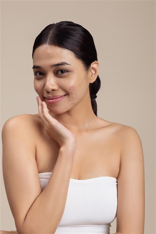 How to Build a Basic Skincare Routine for Acne-Prone Skin