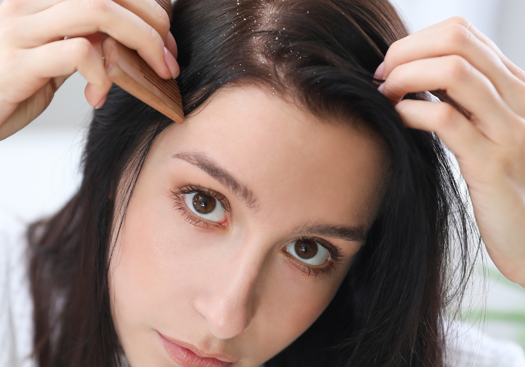 Dry Scalp vs. Dandruff: Key Differences and Effective Treatments
