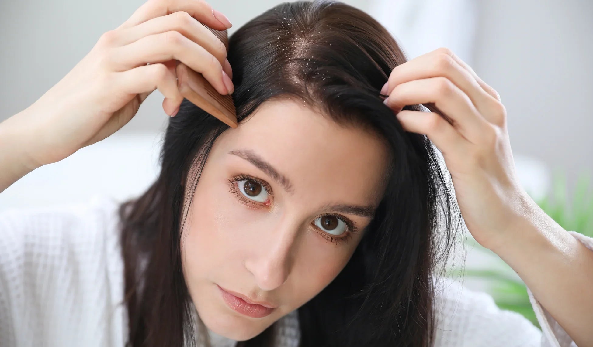 Is It Dry Scalp or Dandruff? Learn the Differences and Find Solutions